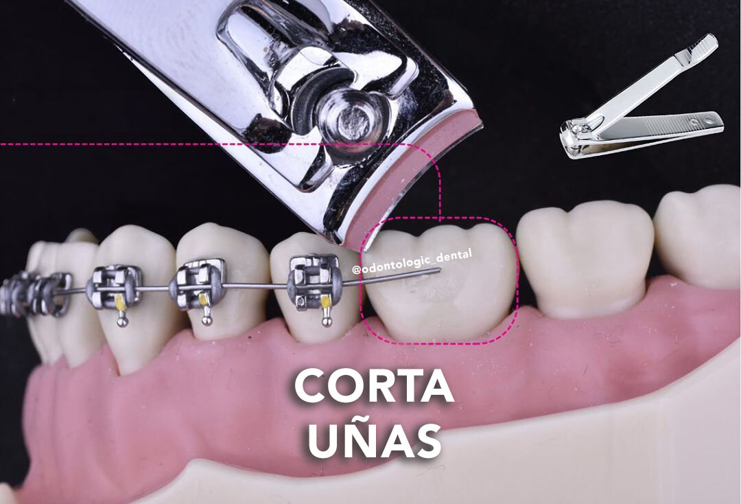 Cómo tratar algunas urgencias de Ortodoncia en casa (Parte 2) — Odontologic